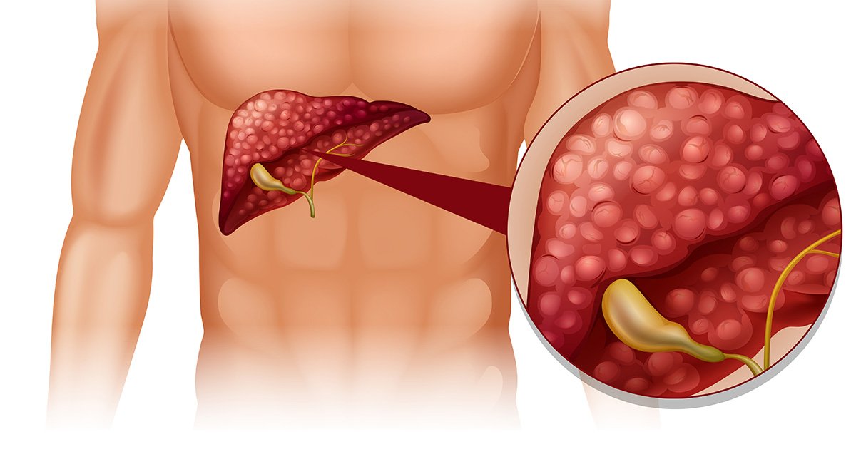 Ilustração do abdômen humano com destaque para o fígado, localizado no lado direito do corpo. Um círculo de ampliação mostra o órgão com aspecto avermelhado e a presença de acúmulo de gordura em suas células